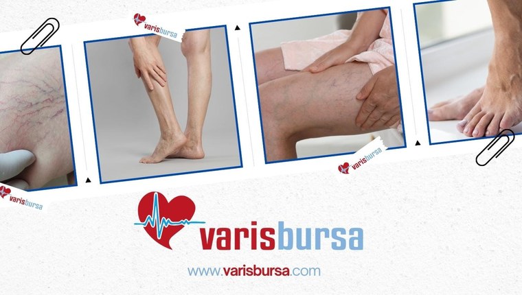 Ameliyatsız Varis Tedavisi