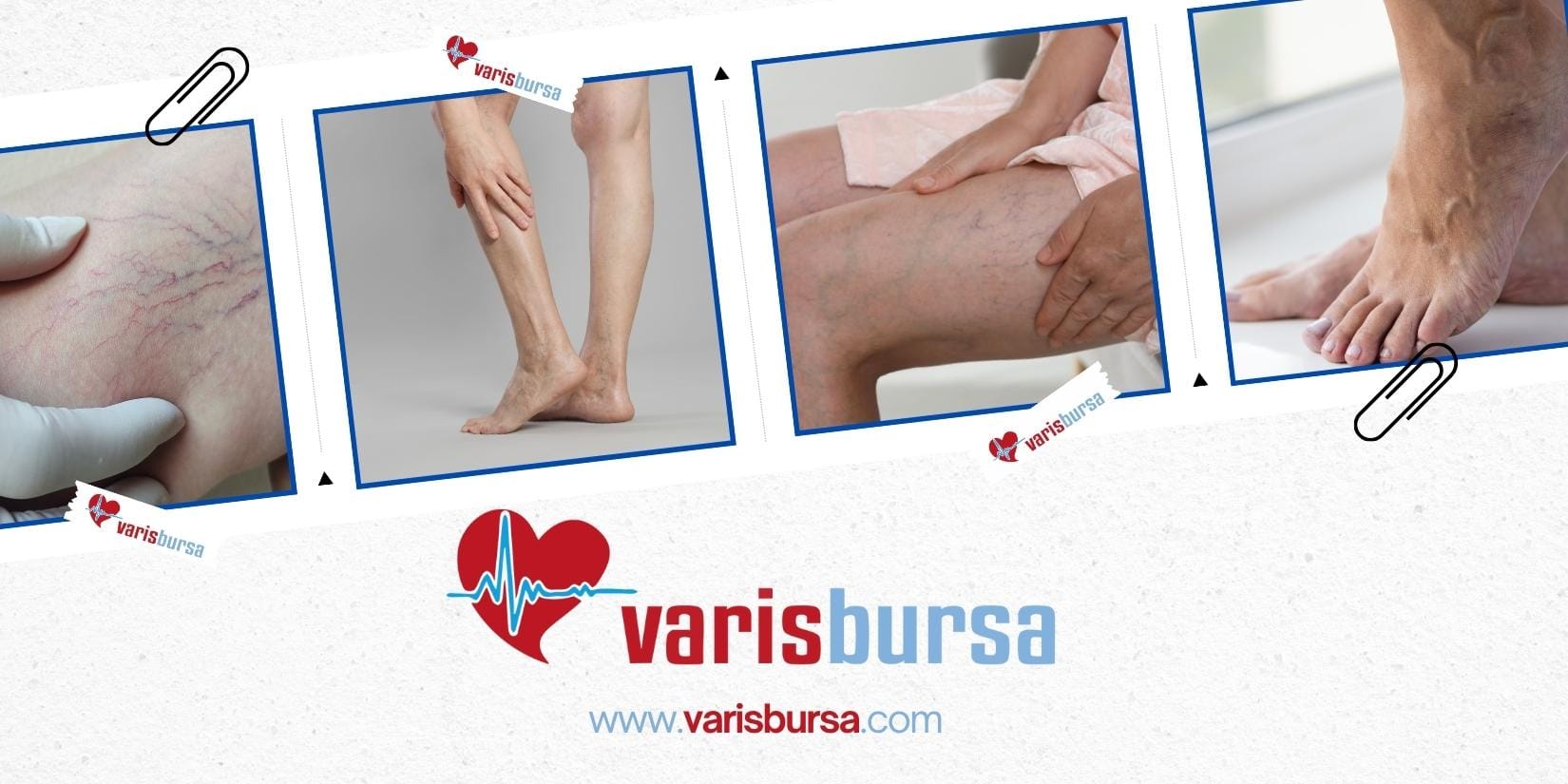 Bursa Varis Tedavi Merkezi